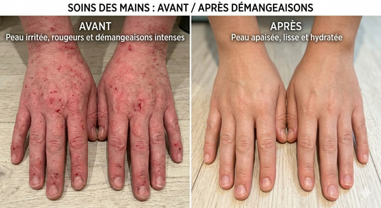 Savon antifongique naturel : comment ça marche vraiment ?